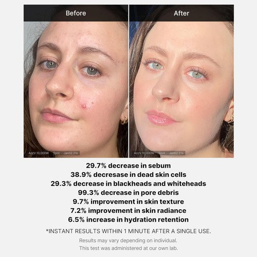 MEDICUBE - Red Acne Succinic Acid Peel - 40g